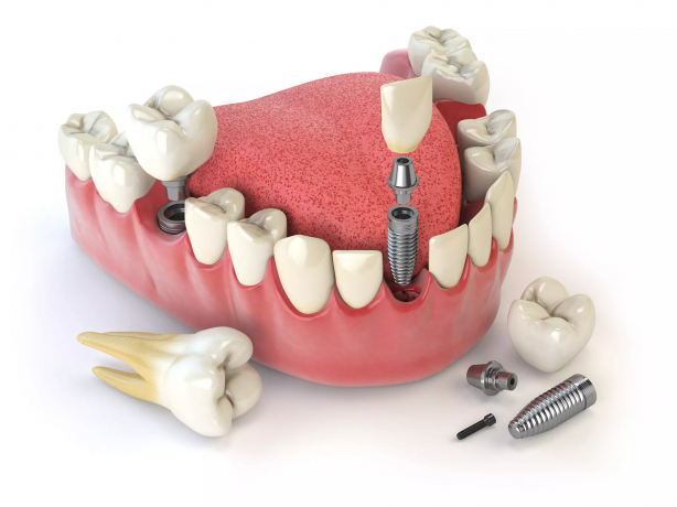 Can Dental Implants in Dubai be done for front teeth?