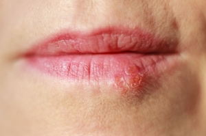 How to Heal Herpes Sores Faster? How to Heal Herpes Sores Faster?
